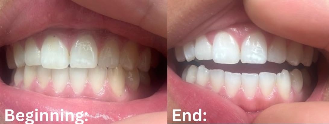 Luz de Blanqueamiento Dental EOICCEOH