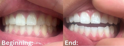 Luz de Blanqueamiento Dental EOICCEOH